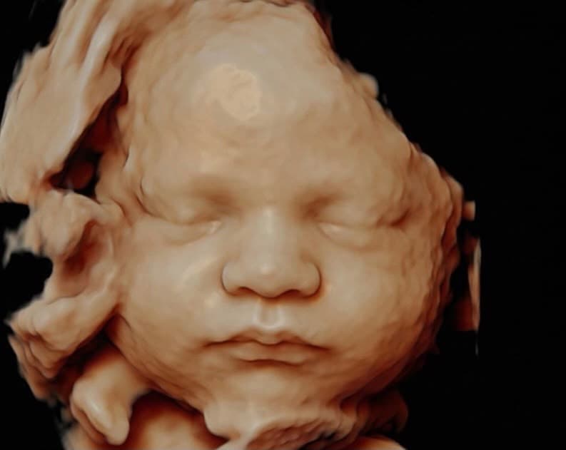 Bebeğin yüzünü önden gösteren üç boyutlu ultrason görüntüsü.