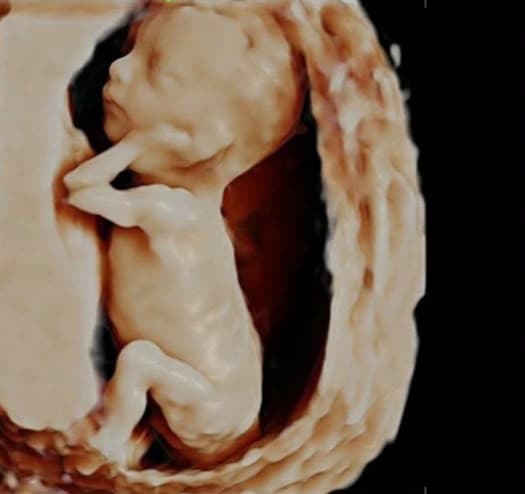 Kolları yüzüne yakın, bacakları bükülü bebeğin başını ve gövdesini gösteren üç boyutlu ultrason görüntüsü.